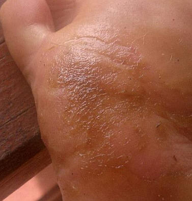 How hemp oil cured my plantar's wart in ten days flat